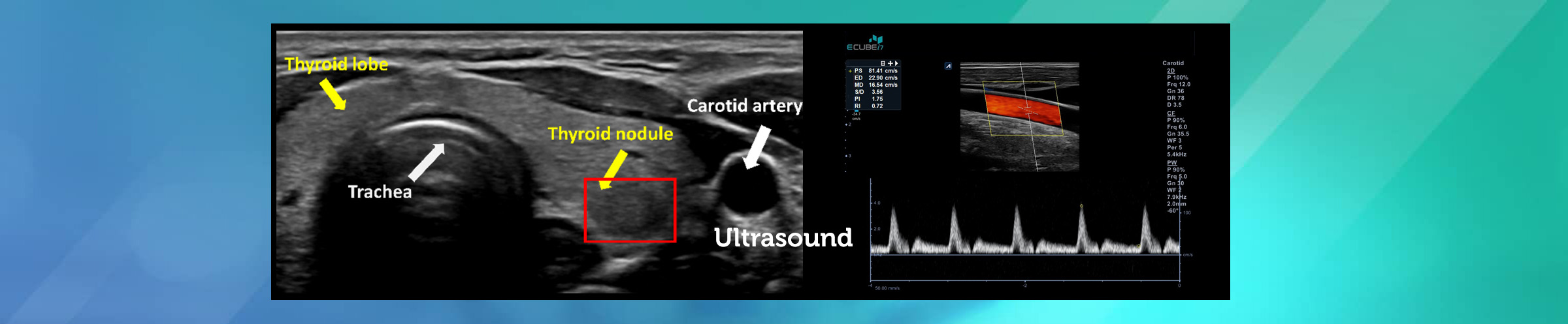 Breast, Thyroid and Carotid Ultrasound